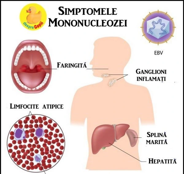 Mononucleoza infecțioasă sau boala sărutului